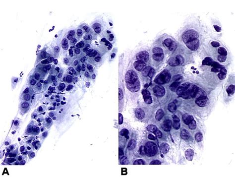 Atypical Cells Cervix