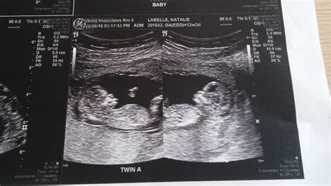 12.5wks-ultrasound - Twiniversity