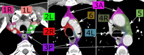 Mediastinal Lymph Nodes Map