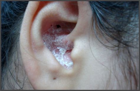 Psoriasis in ear canal pictures | Psoriasis expert