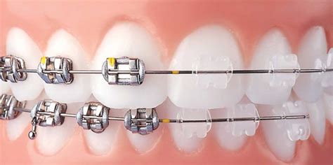 Orthodontics Australia | How are metal and ceramic braces different?