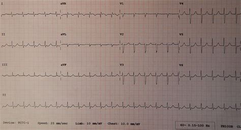 What is the Difference Between Junctional and Idioventricular Rhythm ...