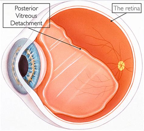 Posterior Vitreous Detachment and Floaters