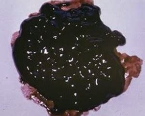 Black Stool Pictures, Causes, Meaning, Symptoms, Treatment