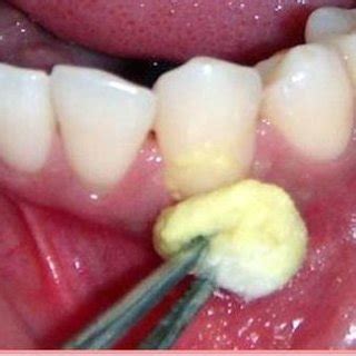 Lateral Pedicle Graft Taken From Adjacent Donor Site. | Download Scientific Diagram