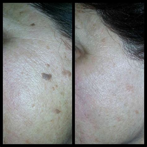 Skin Classic Treatment | Laser Alternative | Kitzie Spa