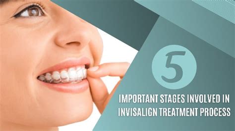 5 Important Stages Involved in Invisalign Treatment Process