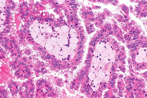 Papillary renal cell carcinoma - Libre Pathology