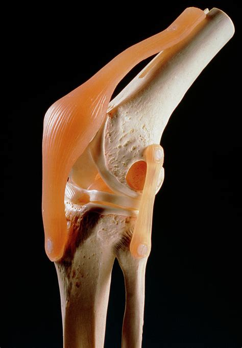 Artificial Knee Joint Photograph by Medical Photo Nhs Lothian/science ...