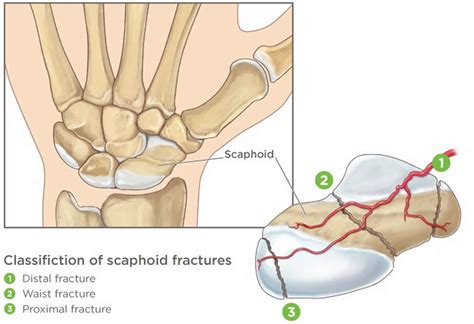 Scaphoid fracture causes, symptoms, diagnosis, treatment & revovery time