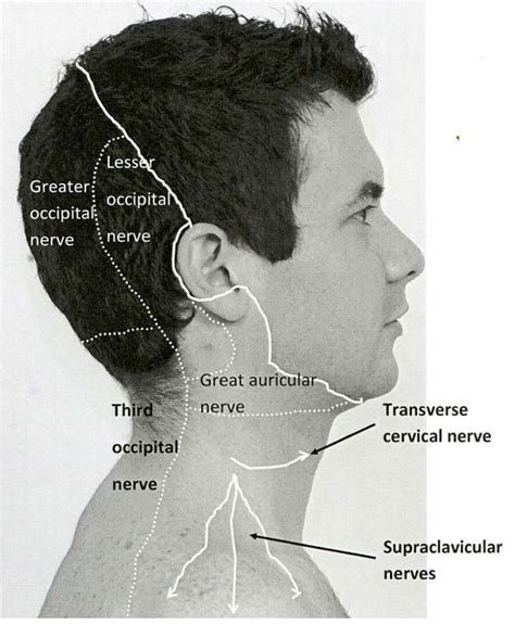 Third Occipital Nerve Headache - Headache