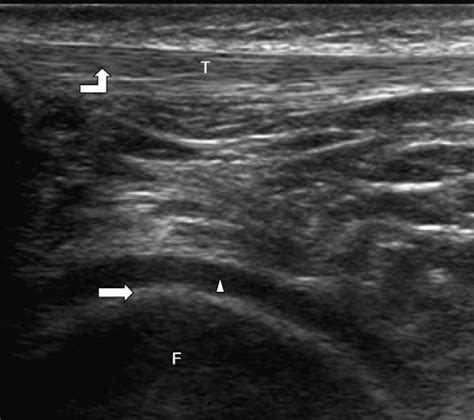 Description of echogenicity. A bright echo on the image is referred to ...