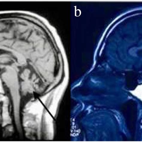 Neuroradiological examination by magnetic resonance imaging (MRI): (a ...