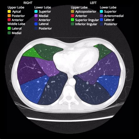 Bronchopulmonary segments: annotated CT | Radiology Case | Radiopaedia.org