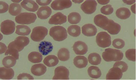 Malaria rapid diagnostic test and Giemsa – stained peripheral blood ...