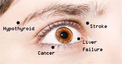 8 Things Your Eyes Are Trying To Tell You About Your Health