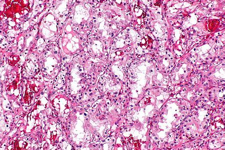 Renal cell carcinoma grading - Libre Pathology