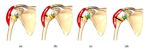 JCM | Free Full-Text | Lateralization in Reverse Shoulder Arthroplasty