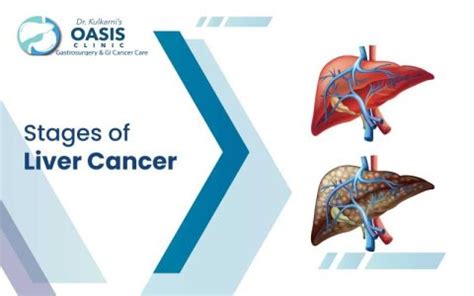 Stages of Liver Cancer | Dr. Aditya Kulkarni - Oasis Clinic