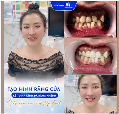 TẠO HÌNH RĂNG CỬA - KẾT HỢP ĐÍNH ĐÁ RĂNG KHỂNH CHO BẠN NỤ CƯỜI TRẮNG SÁNG