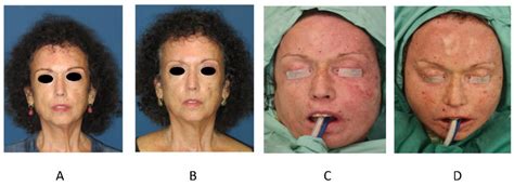 Life | Free Full-Text | Total Facial Autologous Fat Grafting for Treating Skin Manifestations in ...