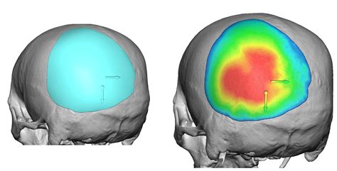 » Blog ArchiveCase Study - Custom Skull Implant for Occipital Plagiocephaly