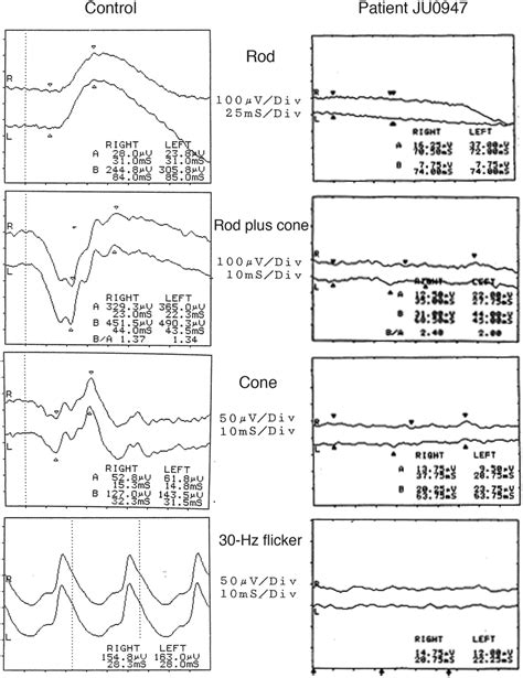 Patient full-field electroretinography results. Full-field... | Download Scientific Diagram