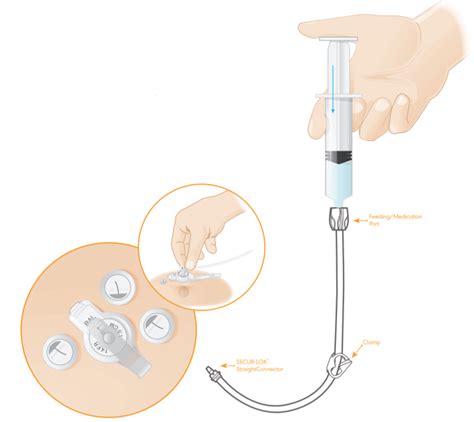 Mic-key Gastrostomy Feeding Tube 20 Fr | scs-oman.com