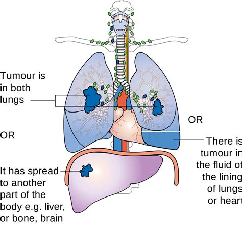 lung cancer - what is cancer - prostate cancer - pancreatic cancer: May 2015