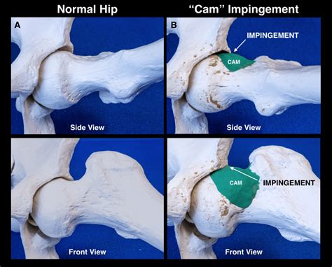 Hip Impingement Post Surgery Recovery at Charlie Posada blog