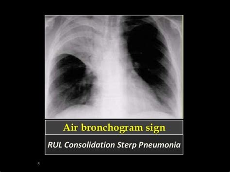 A pictorial review of “signs in thoracic imaging 01”