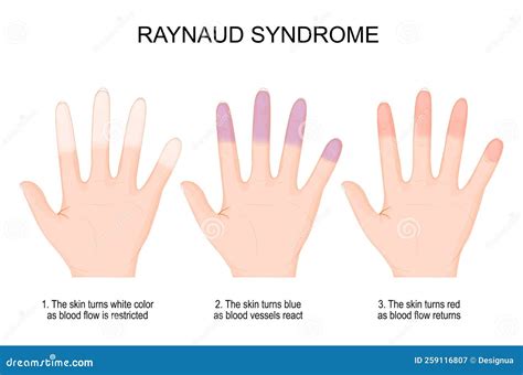 Hands Of A Person With Raynaud`s Phenomenon From White Color When Blood Flow Is Restricted To ...