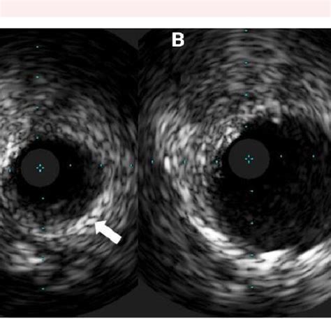 Intravascular ultrasound images at the ostium of the left main coronary ...