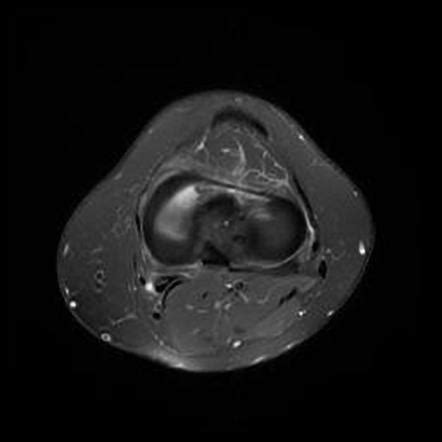 Transverse Perineal Ligament