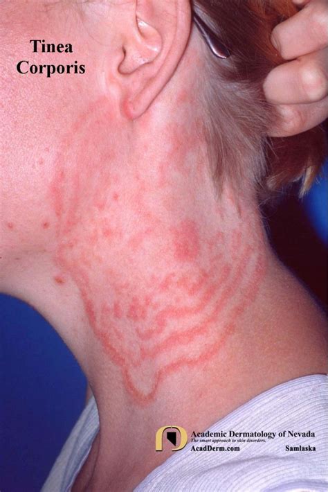 Tinea Corporis: Ringworm, Tinea Circinata... - Academic Dermatology of Nevada