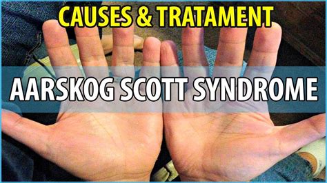 What is Aarskog Scott Syndrome, Causes, Symptoms and Treatments - YouTube