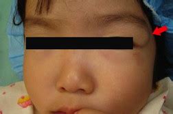 Two cases of steatocystoma simplex in infants