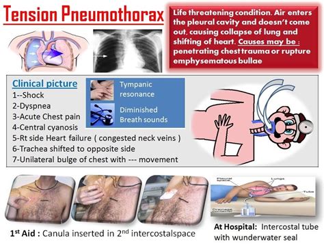 Tension pneumothorax: rapidly developing, life threatening. air leak causes increased pressure ...