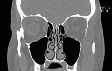 Best CT Scan Center for CT PNS in Nanded City Pune