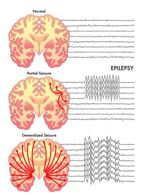 Can Essential Oils Help With Seizures And Epilepsy | Essential Oil Benefits