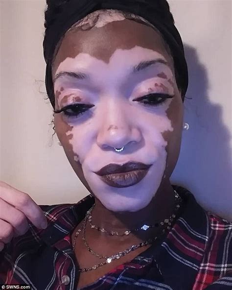 Woman with heart-shaped vitiligo patch on her face goes makeup-free | Daily Mail Online