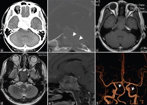 Surgical Neurology International