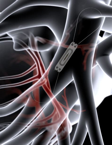 Cardiomems device - Wessex Cardiology