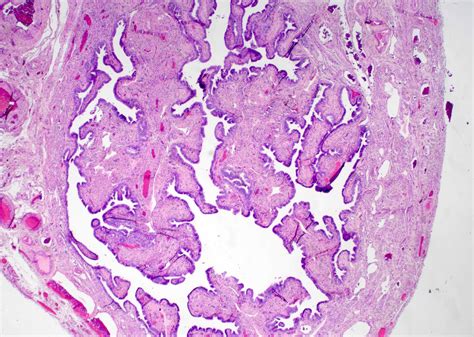 Pathology Outlines - Chronic salpingitis