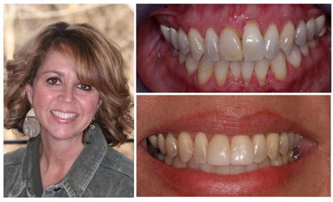 Teeth Bonding in Knoxville TN | Tooth Bonding to Repair Teeth