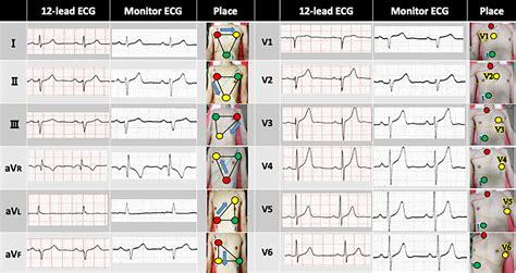 Ecg Leads