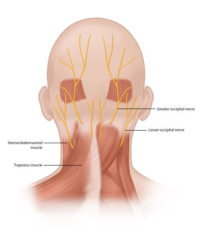 Occipital Neuralgia Treatment | Headache Pain Relief | Pain Spa, Bristol, UK