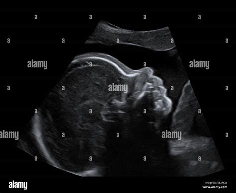 Ultrasound scan of a foetus, Gestational age : 26 weeks and 4 days ...