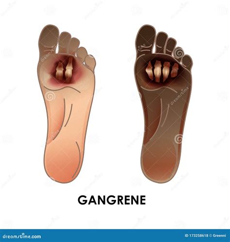 Diabetic Foot. Gangrene stock illustration. Illustration of gangrene - 173258618