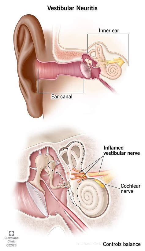 Vestibular neuritis symptoms causes treatment – Artofit